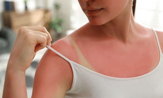 how to heal sunburnt skin fast